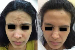 botox