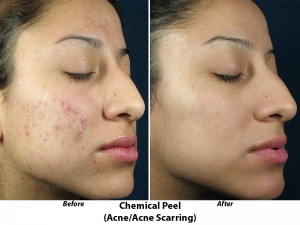 chemical peels acne