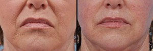 fillers