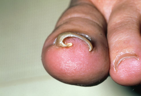 ingrowingtoenail