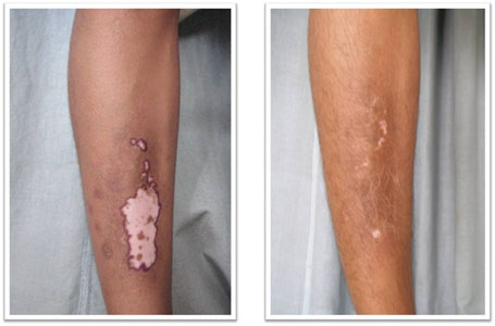 vitiligo2