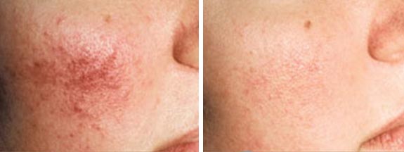 rosacea